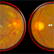Central Retinal Vein Occlusion Central Retinal Vein Occlusion