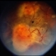 Angioma from Chronic Retinal Detachment Angioma from Chronic Retinal Detachment