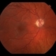 Pseudo-Foster Kennedy syndrome