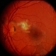 Peripapillary CNVM / Uveitis Peripapillary CNVM / Uveitis