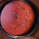 Hypotony maculopathy Hypotony maculopathy