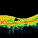 Perifoveal Telangiectasia With CNVM Perifoveal Telangiectasia With CNVM