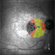 Dry AMD Microperimetry