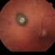 Benign Nevus