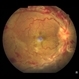 Central Retinal Vein Occlusion