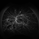 Proliferative Diabetic Retinopathy Angiography Proliferative Diabetic Retinopathy Angiography