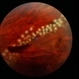 Angioma from Chronic Retinal Detachment Angioma from Chronic Retinal Detachment