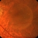 Acquired Optic Pit Maculopathy Acquired Optic Pit Maculopathy