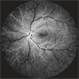 Takayasu Retinopathy Takayasu Retinopathy