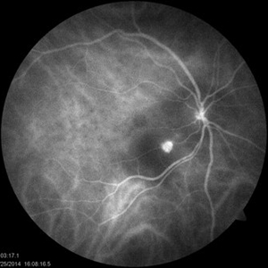 PCV post antiVEGF vs post PDT - Retina Image Bank