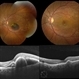 Submacular Hemorrhage Due to Malattia Leventinese Submacular Hemorrhage Due to Malattia Leventinese