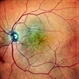 SUB-RETINAL NEOVASCULAR MEMBRANE SUB-RETINAL NEOVASCULAR MEMBRANE
