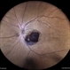 Retinal Macroaneurysm