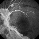 Lupus Retinopathy Lupus Retinopathy