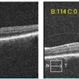 Macular Hole Observed