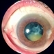 Subluxated cataract Subluxated cataract