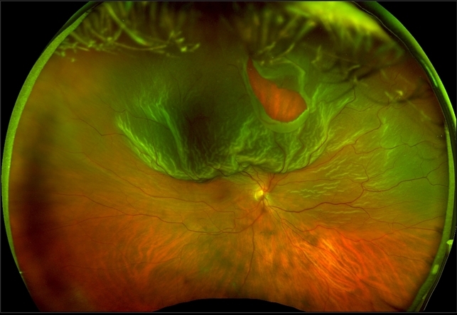 Optos Giant Tear within Retinal Detachment - Retina Image Bank