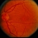 Macular Hole Evolving / Lamellar Hole Macular Hole Evolving / Lamellar Hole
