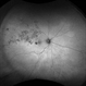 Branch Retinal Vein Occlusion