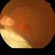 Choroidal Coloboma With Retinal Detachment Status Post Surgery Choroidal Coloboma With Retinal Detachment Status Post Surgery
