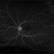 Peripheral Retinal Ischemia Peripheral Retinal Ischemia