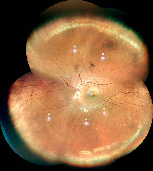 Lattice degeneration retina image bank