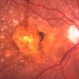 Occult ARMD, Color Fundus Photograph