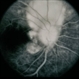 Scleritis / OIS Scleritis / OIS