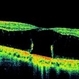 Bilateral Myopic Foveoschisis