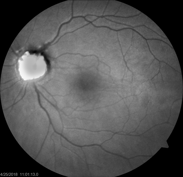 Fundus Autofluorescence Of Optic Disc Drusen Retina Image Bank