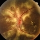 Hypertensive Retinopathy Hypertensive Retinopathy