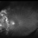 Coats' Disease on Ultra-Wide Field Fluorescein Angiography Coats' Disease on Ultra-Wide Field Fluorescein Angiography