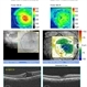 Comparison Before and After Treatment of Large Macular Hole Using a Petalloid ILM Flap Comparison Before and After Treatment of Large Macular Hole Using a Petalloid ILM Flap
