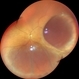 Intraocular Mass With Retinal Detachment Intraocular Mass With Retinal Detachment