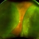 Non-Kissing Choroidal Detachment Non-Kissing Choroidal Detachment