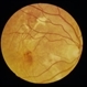 Subretinal Fibrosis Subretinal Fibrosis