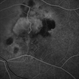 Neovascular Membrane Neovascular Membrane