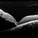 Retinal Detachment Sparing Fovea By Microns Retinal Detachment Sparing Fovea By Microns