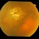 Subfoveal Bleed From Extramacular CNVM