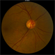 Radiation Retinopathy Radiation Retinopathy