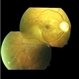 Branch Retinal Artery Occlusion With Embolus