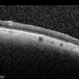 Tilted Disc Syndrome Complicated with RPE Atrophy and Polypoidal Choroidal Vasculopathy Tilted Disc Syndrome Complicated with RPE Atrophy and Polypoidal Choroidal Vasculopathy