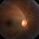 Lipemia-OD Lipemia-OD