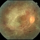 Proliferative Diabetic Retinopathy Proliferative Diabetic Retinopathy