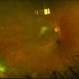 Proliferative Sickle Cell Retinopathy, Color OD