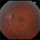 Genetic Macular Dystrophy