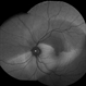 Branch Retinal Artery Occlusion With Calcium Embolus at the Disc - Fundus Autofluorescence Imaging (FAF) Branch Retinal Artery Occlusion With Calcium Embolus at the Disc - Fundus Autofluorescence Imaging (FAF)
