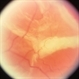 Outer Layer Holes with Rolled Edges in Retinoschisis Outer Layer Holes with Rolled Edges in Retinoschisis