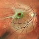 Epiretinal Membrane with Macular Hole Epiretinal Membrane with Macular Hole