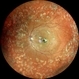 JXT and Proliferative Diabetic Retinopathy JXT and Proliferative Diabetic Retinopathy